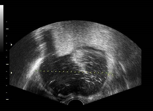 Ovarian Swellings and Screening for Ovarian Cancer - Gynecology Ultrasound